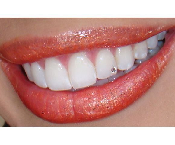 Οδοντικό Στραs