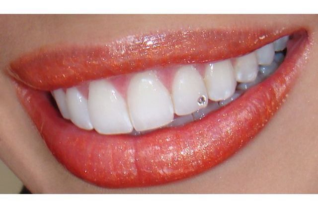 Οδοντικό Στρας (Strass), τι είναι; πως γίνεται; Οδοντικό Στρας (Strass), τι είναι; πως γίνεται;