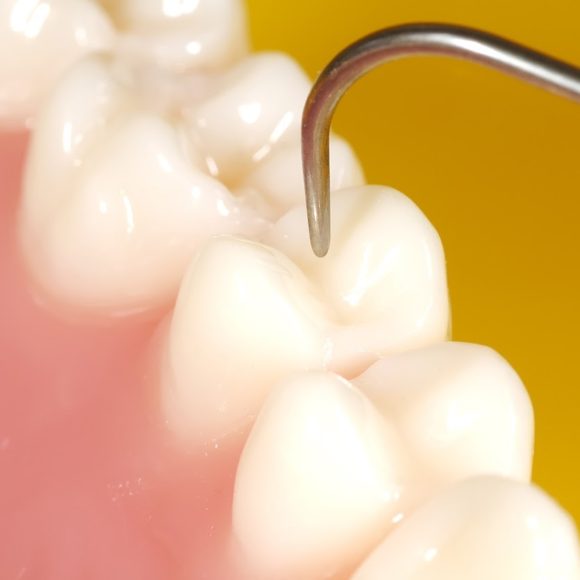 Λευκά (αισθητικά) σφραγίσματα