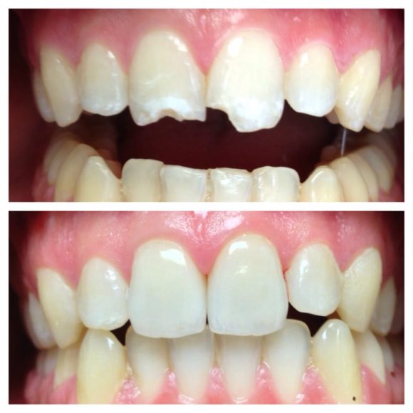 Τεχνική Dental Bonding