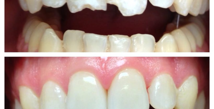 Τεχνική Dental Bonding. Τι είναι; Πως γίνεται; Τεχνική Dental Bonding. Τι είναι; Πως γίνεται;