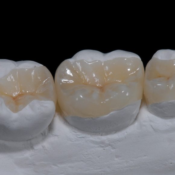 Ένθετα και επένθετα δοντιών.