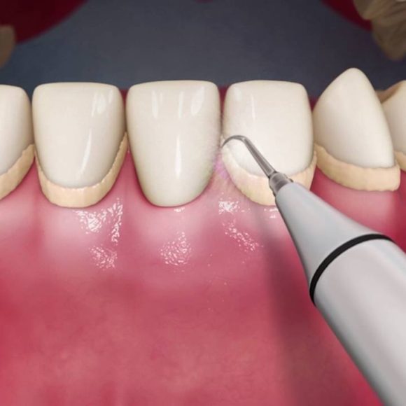 Καθαρισμός (Αποτρύγωση και στίλβωση δοντιών)