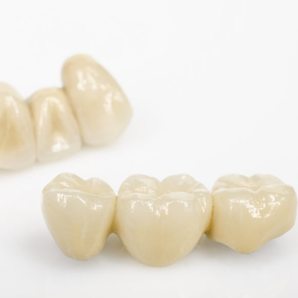 Γέφυρες και θήκες δοντιών.