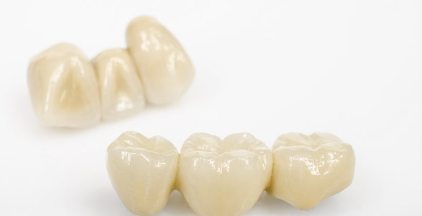 Γέφυρες και θήκες δοντιών. Γέφυρες και θήκες δοντιών.