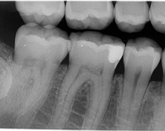 Ακτινογραφική εξέταση (Ψηφιακή Ακτινογραφία)