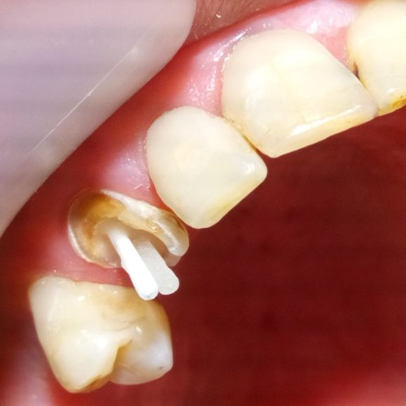 Ανασύσταση δοντιού με άξονα