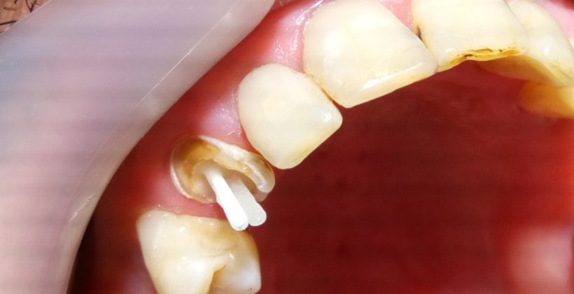 Ανασύσταση δοντιού με άξονα Ανασύσταση δοντιού με άξονα