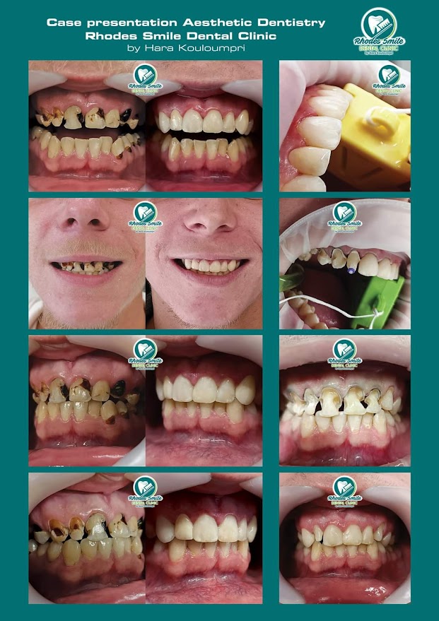 Από τον πολυτερηδονισμό σε ένα υγιές και αισθητικά ισορροπημένο χαμόγελο Από τον πολυτερηδονισμό σε ένα υγιές και αισθητικά ισορροπημένο χαμόγελο