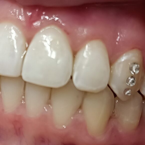 Οδοντικό στρας: Μια διακριτική λάμψη στο χαμόγελο