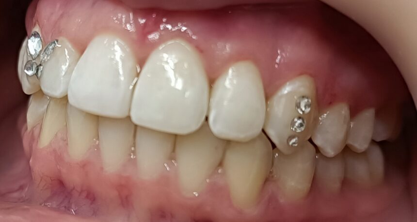 Οδοντικό στρας: Μια διακριτική λάμψη στο χαμόγελο Οδοντικό στρας: Μια διακριτική λάμψη στο χαμόγελο