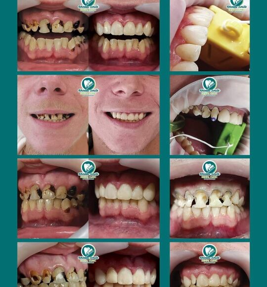Smile transformation: From Severe Tooth Decay to a Healthy, Confident Smile Smile transformation: From Severe Tooth Decay to a Healthy, Confident Smile