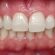 In-Office Teeth Whitening