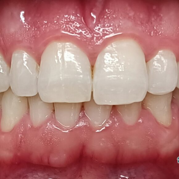 In-Office Teeth Whitening