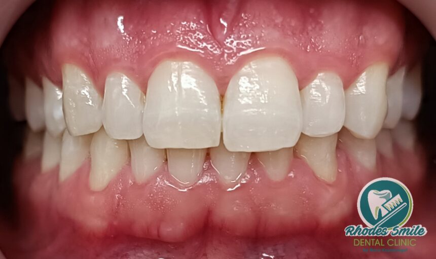 In-Office Teeth Whitening In-Office Teeth Whitening