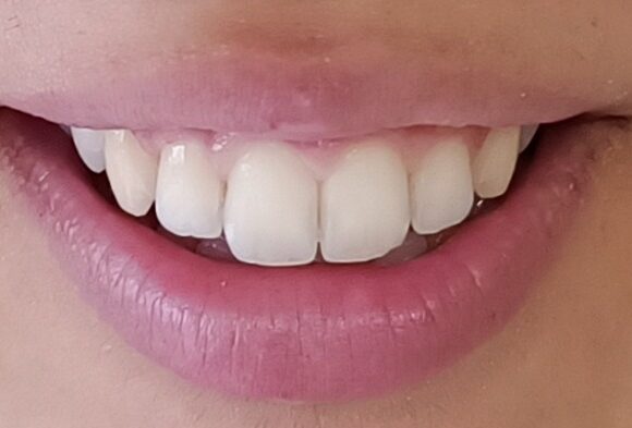 Professional Dental Cleaning Professional Dental Cleaning